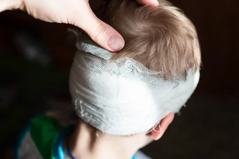 A child with a bandaged head. A pre-school boy with a head injury. Childhood trauma. Dissection of the scalp in preschool children